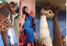 Doctors finally amputate Leg of lady crushed by Patience Jonathan’s cousin